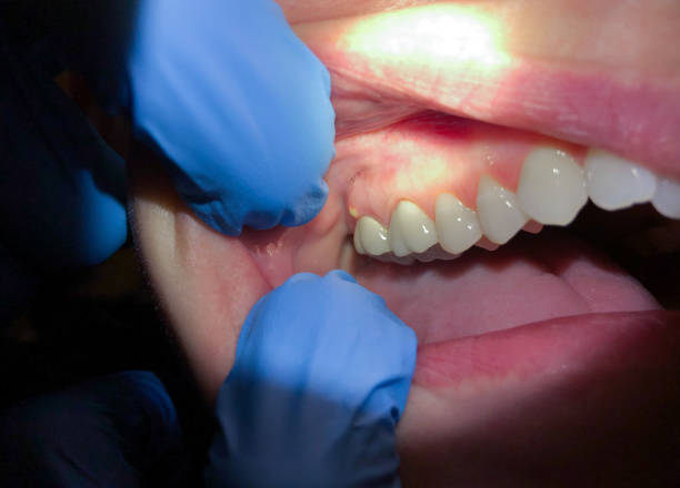 Best Emergency Root Canal Treatment in Bloomington, MN